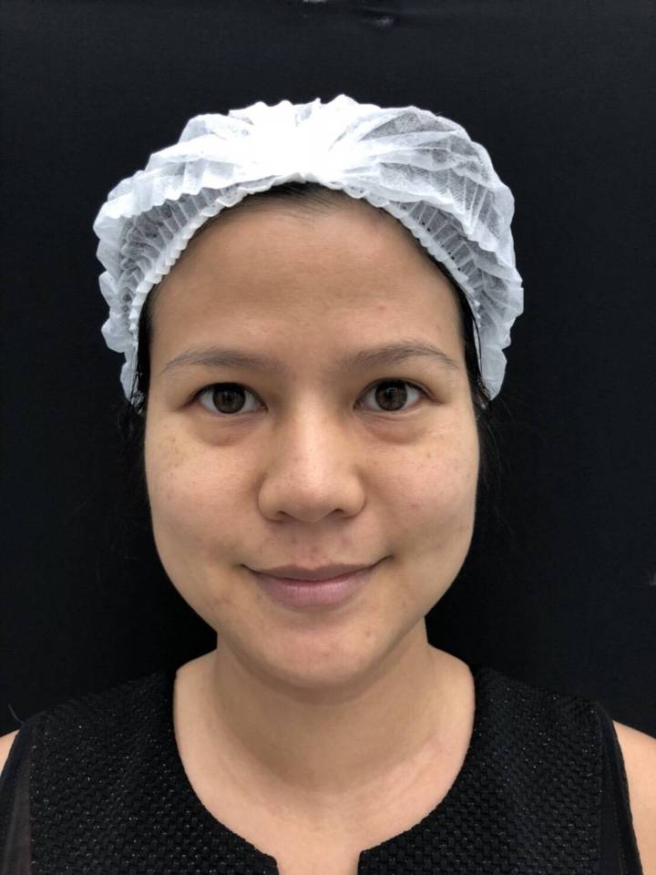 caanteen ulthera isky center49